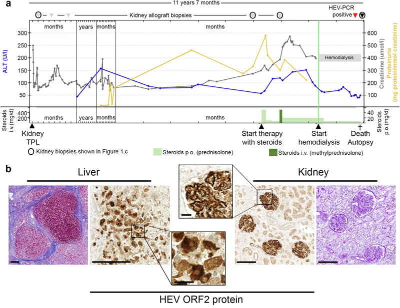 
戊型肝炎腎移植受者膜增殖型免疫復(fù)合物腎小球腎炎的臨床過程、尸檢結(jié)果和逐漸發(fā)展