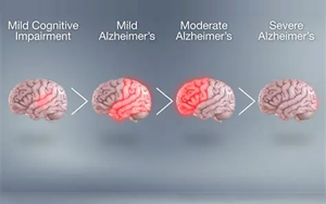基因-代謝組-飲食互作在癡呆風(fēng)險(xiǎn)中的精準(zhǔn)預(yù)防：APOE4純合子特異性代謝通路與地中海飲食的調(diào)控作用