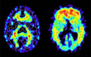 新冠帶來新的“醫(yī)療壓力”：阿爾茨海默病的風險飆升50%-80%