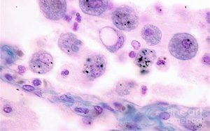 Science Immunology：巨噬細胞發(fā)育缺陷導(dǎo)致肺部疾病