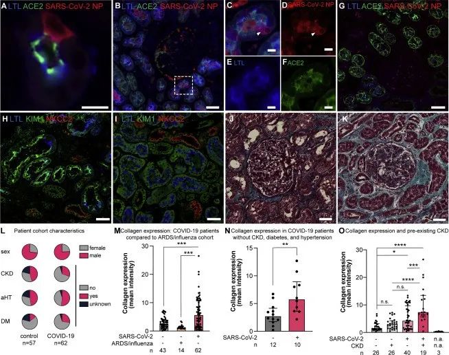 新冠病毒存在于感染者的腎細胞中并誘導腎臟纖維化 新冠病毒存在于感染者的腎細胞中并誘導腎臟纖維化