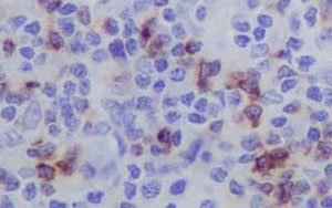 早期預(yù)測CAR-T細(xì)胞治療反應(yīng)的新生物標(biāo)志物