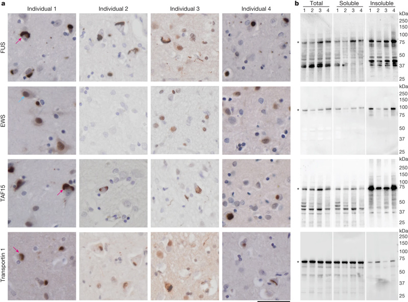 額顳葉退化蛋白包含FET蛋白和遠轉蛋白1 額顳葉退化蛋白包含FET蛋白和遠轉蛋白1