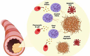 NEJM綜述：淀粉樣變性的發(fā)病機(jī)制、研究和治療