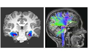 Nature Medicine：一種新的強(qiáng)迫癥神經(jīng)生物標(biāo)志物